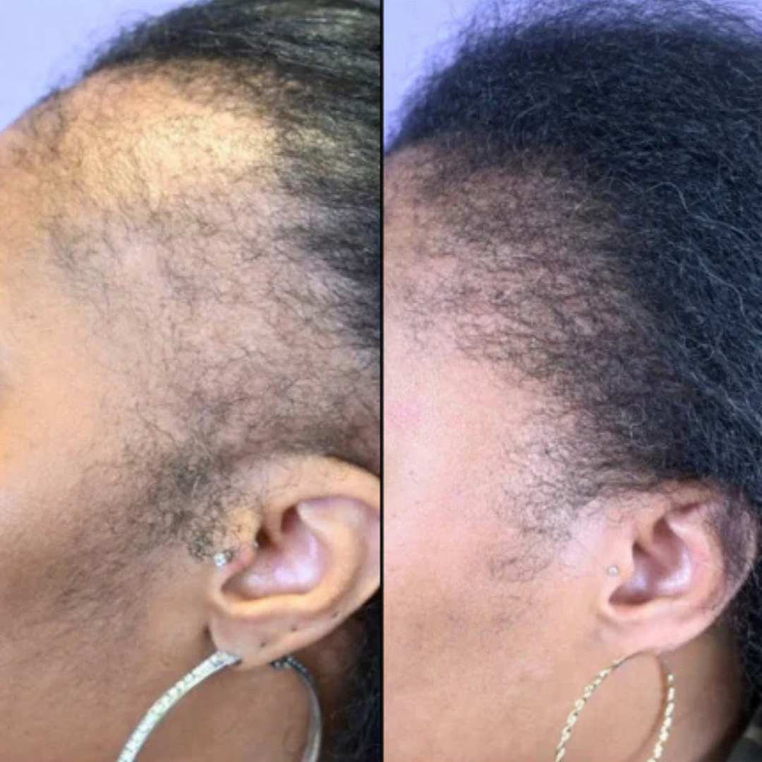Stoppez la chute de cheveux et faites repousser vos tempes dégarnies en 14 jours — sans traitement chimique. (BN)