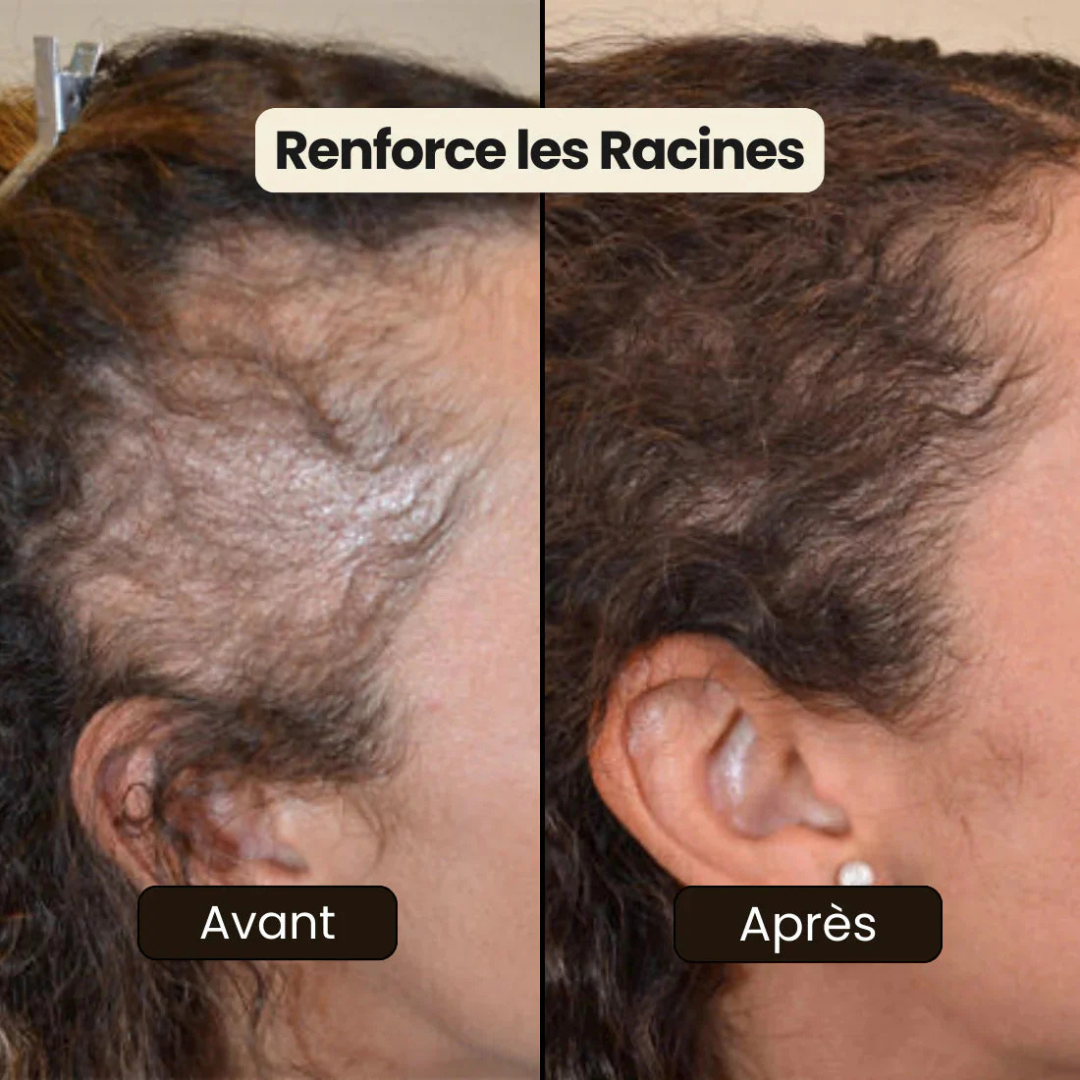 Stoppez la chute de cheveux et faites repousser vos tempes dégarnies en 14 jours — sans traitement chimique. (BN)